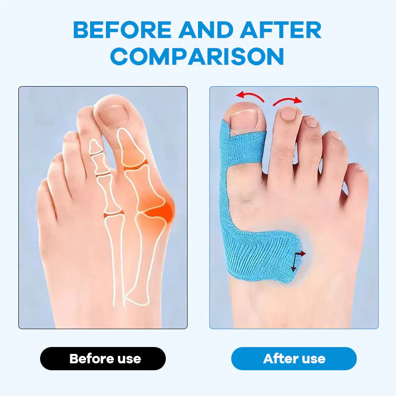 👣Pre-cut Hallux Valgus Corrector Kinesiology Tape